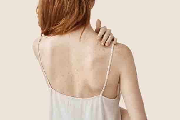 Tips to reduce Back Acne